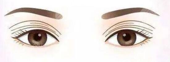 雙眼皮