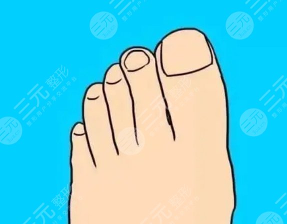 腳趾縮短手術(shù)