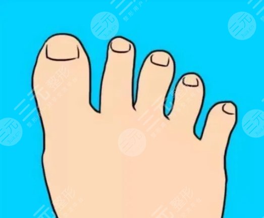 二腳趾縮短手術(shù)