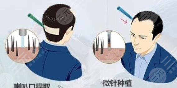 上海同濟(jì)醫(yī)院植發(fā)價(jià)格怎么樣