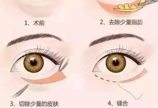 上海東方醫(yī)院去眼袋掛什么科