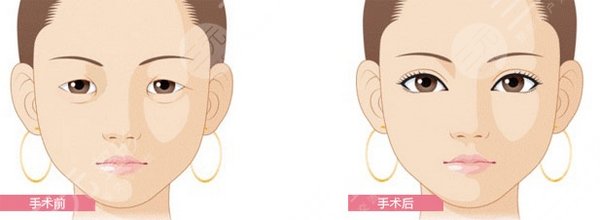 長沙希美醫(yī)療美容怎么樣？兩位醫(yī)生強項介紹，雙眼皮案例測評！