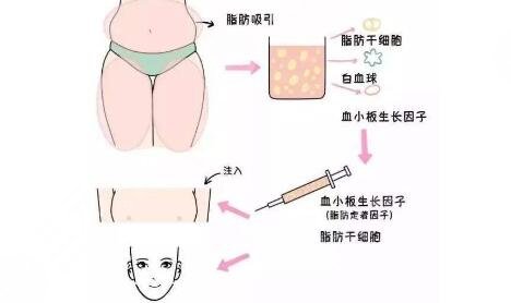 自體脂肪填充面部