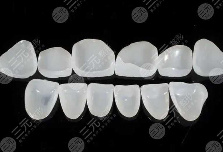 上海東方醫(yī)院牙齒科牙齒貼面案例