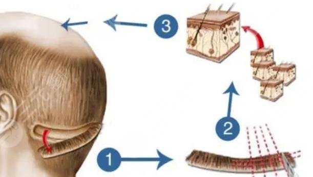 上海九醫(yī)院植發(fā)好不好?