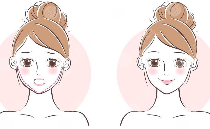 發(fā)腮臉變寬了還能變回去不？