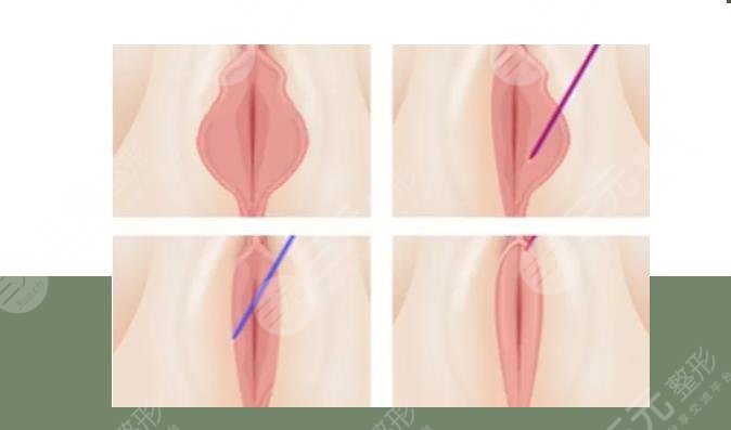 女性私密緊致手術(shù)后的改變好嗎
