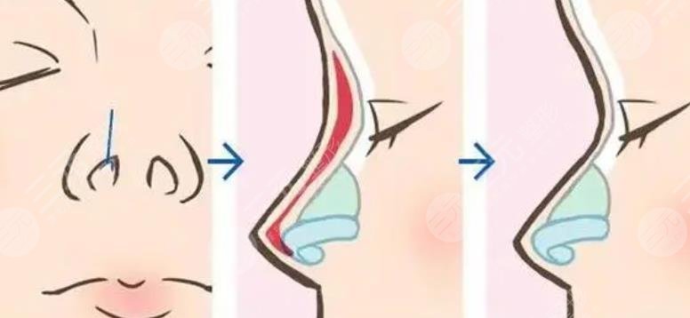 沈國雄醫(yī)生鼻子整形案例