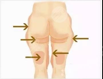 曾德浩醫(yī)生吸脂怎樣？簡介&案例測評！廣州荔醫(yī)高人氣之選~