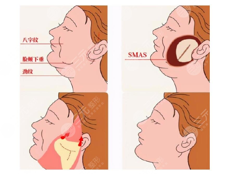 下頜線模糊下垂肉多怎么改良？