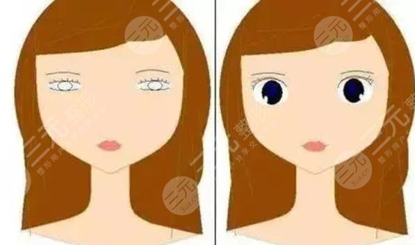 沈國雄醫(yī)生雙眼皮手術(shù)案例