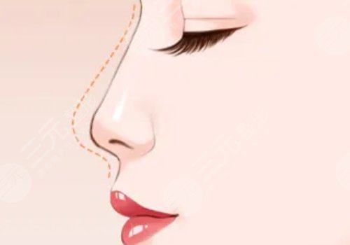 鐘青杰醫(yī)生做鼻子怎樣？