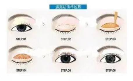 沈國雄醫(yī)生雙眼皮案例