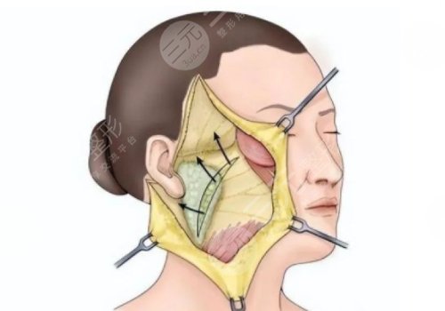 筋膜懸吊面部提升術(shù)價格是多少？
