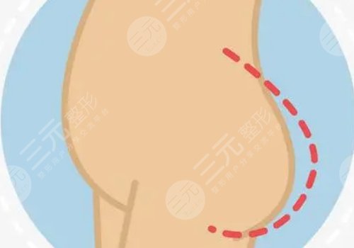 脂肪豐臀多久能恢復(fù)好？