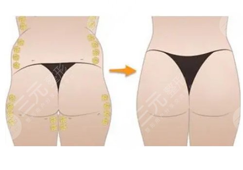 脂肪豐臀多久能恢復(fù)好？