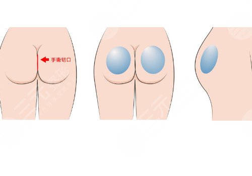 脂肪豐臀多久能恢復(fù)好