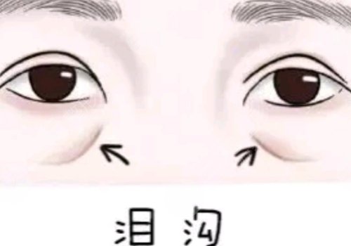 淚溝凹陷怎么解決好？