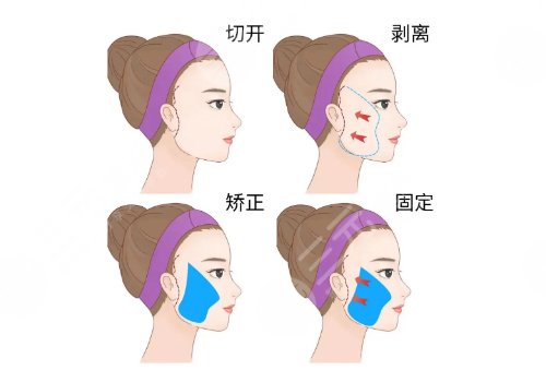 小切口拉皮手術(shù)可以維持多久