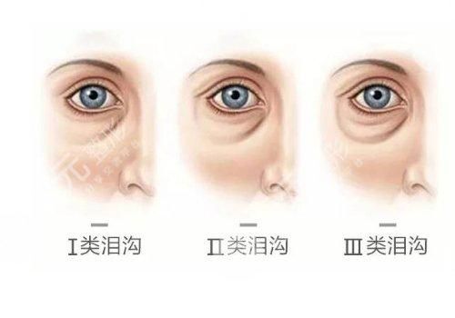 淚溝填充大概要多少錢？