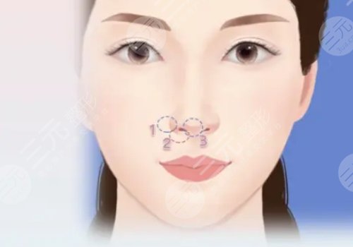 猴化臉鼻基底怎么解決
