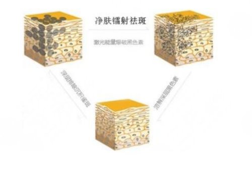 鐳射凈膚儀祛斑會反彈嗎