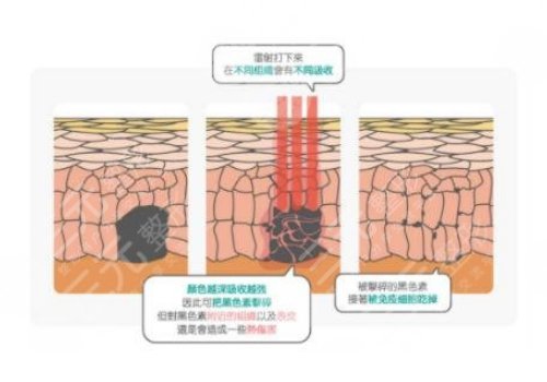 鐳射凈膚儀祛斑會反彈嗎