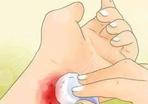 鐳射凈膚儀祛斑有副作用嗎？