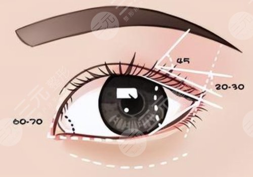 楊瑞年雙眼皮失敗案例