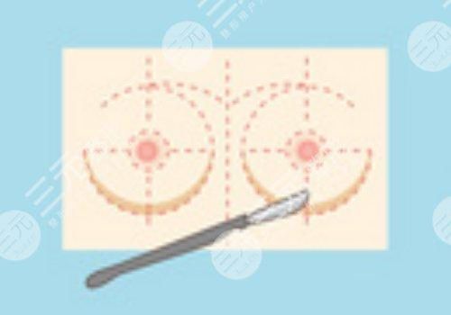 曼托假體好不好？