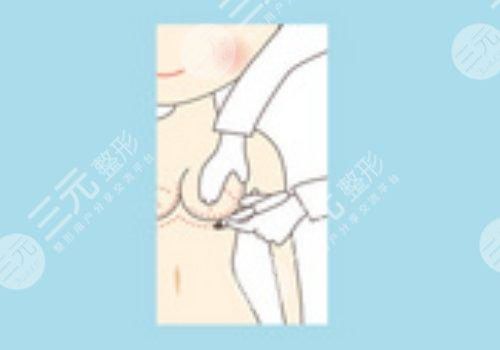 曼托假體好不好？