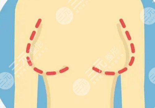 曼托假體好不好？