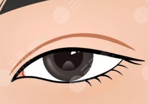 夏國興割雙眼皮怎么樣