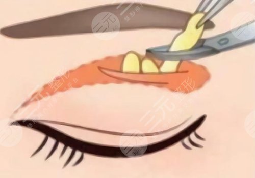 夏國興割雙眼皮怎么樣