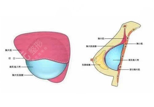 威寧花樣年華假體怎么樣