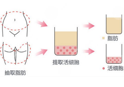 杭州常德成脂肪填充