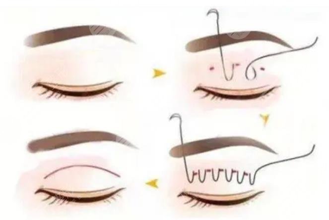 沈國雄醫(yī)生雙眼皮手術(shù)案例