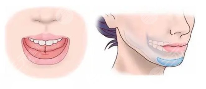 華西醫(yī)院整形科價目表新2023