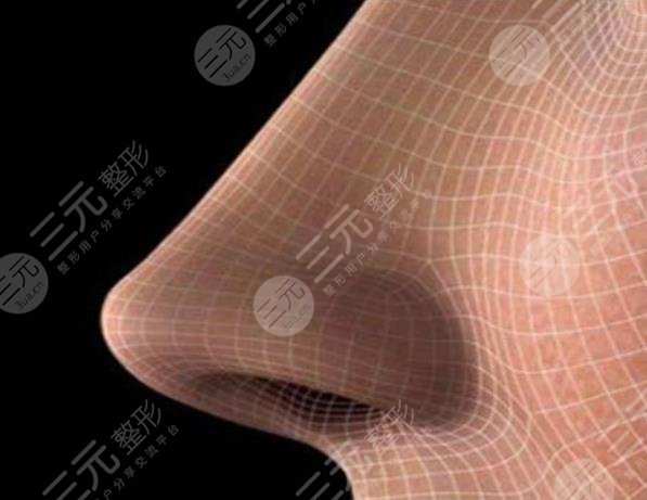 鼻梁注射玻尿酸