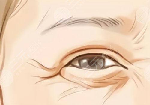 眼部拉皮手術(shù)后會(huì)有哪些后遺癥