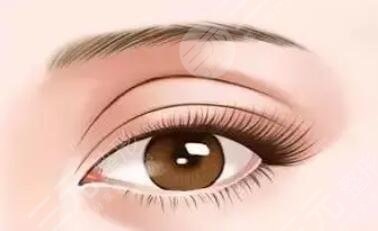 解讀！  小虎做雙眼皮案例