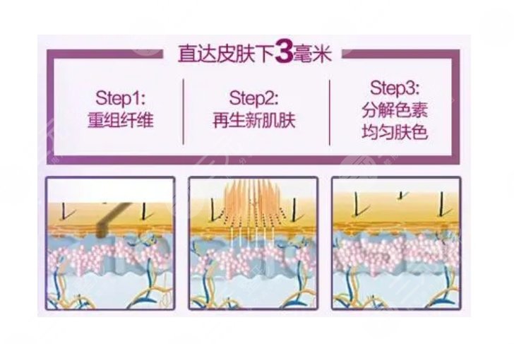 北京美萊整形醫(yī)院祛斑怎么樣
