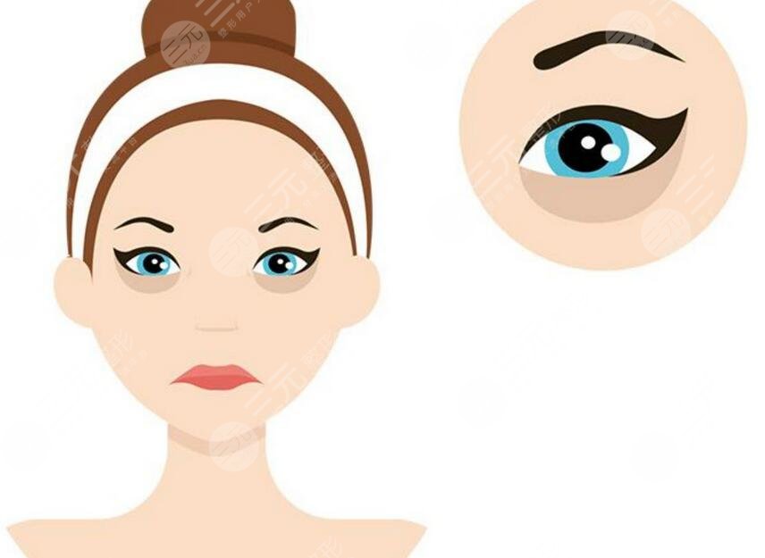 上海市東方醫(yī)院整形外科去眼袋案例