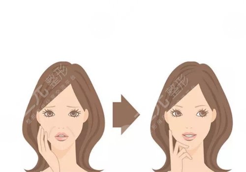 鼻唇溝和法令紋的區(qū)別