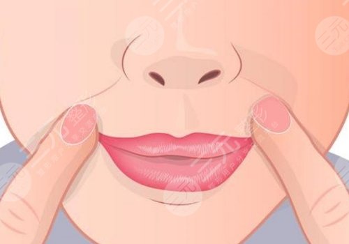 鼻唇溝太深怎么辦