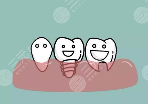 種植牙的過(guò)程步驟