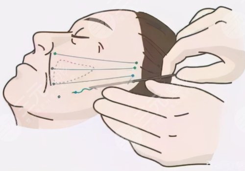 小拉皮手術(shù)可以維持多久