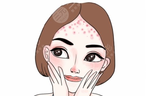 額頭長痘痘