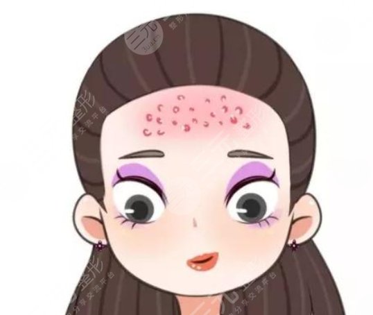 額頭長痘痘
