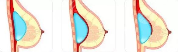 歐陽(yáng)天祥醫(yī)生隆胸案例